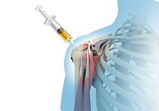 Orthobiologics Treatment for Shoulder