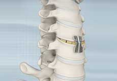 Anterior Cervical Corpectomy & Fusion