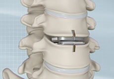 Cervical Spine Surgery