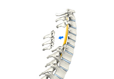 Lumbar Spinal Fusion