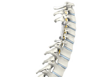 Cervical Spine Fusion