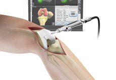 Computer Guided Knee Replacement