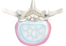 Degenerative Lumbar Spinal Surgery