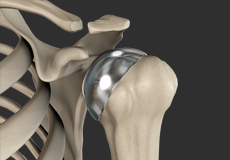 Hip Hemiarthroplasty