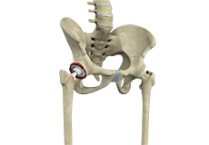 Enhanced Recovery Hip Replacement