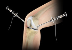 Arthroscopy of the Knee Joint