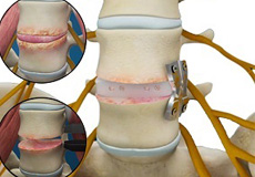 Lateral Lumbar Interbody Fusion