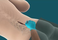 Lower Back (Lumbar) Surgery