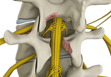 Lumbar Microdecompression