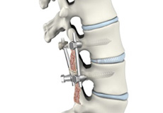 Lumbar Interbody Fusion