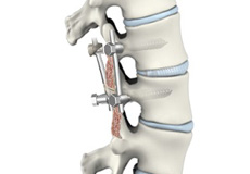 Lumbar Spinal Fusion