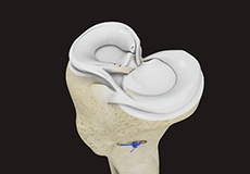 Meniscus Surgery