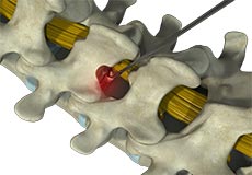 Cervical Microdiscectomy