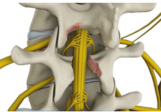 Minimally Invasive Lumbar Decompression