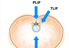 Minimally Invasive Lumbar Fusion