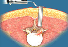 Minimally Invasive Lumbar Surgery