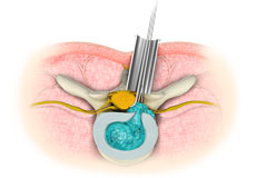 Minimal Invasive Spine Surgery