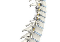 Multilevel Posterior Cervical Laminectomy & Fusion