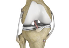 Multi Ligament Reconstruction
