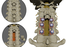 Posterior Cervical Decompression