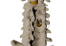 Posterior Cervical Laminectomy & Fusion