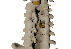 Posterior Cervical Foraminotomy