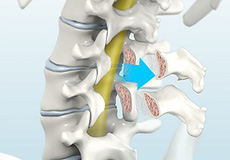 Posterior Lumbar Interbody Fusion