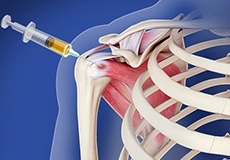 Platelet-Rich Plasma (PRP) Therapy