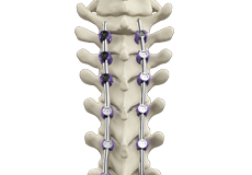 Scoliosis Correction Surgery